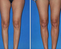 Picture of before and after calf implants